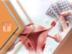 Tratamento farmacológico da endometriose